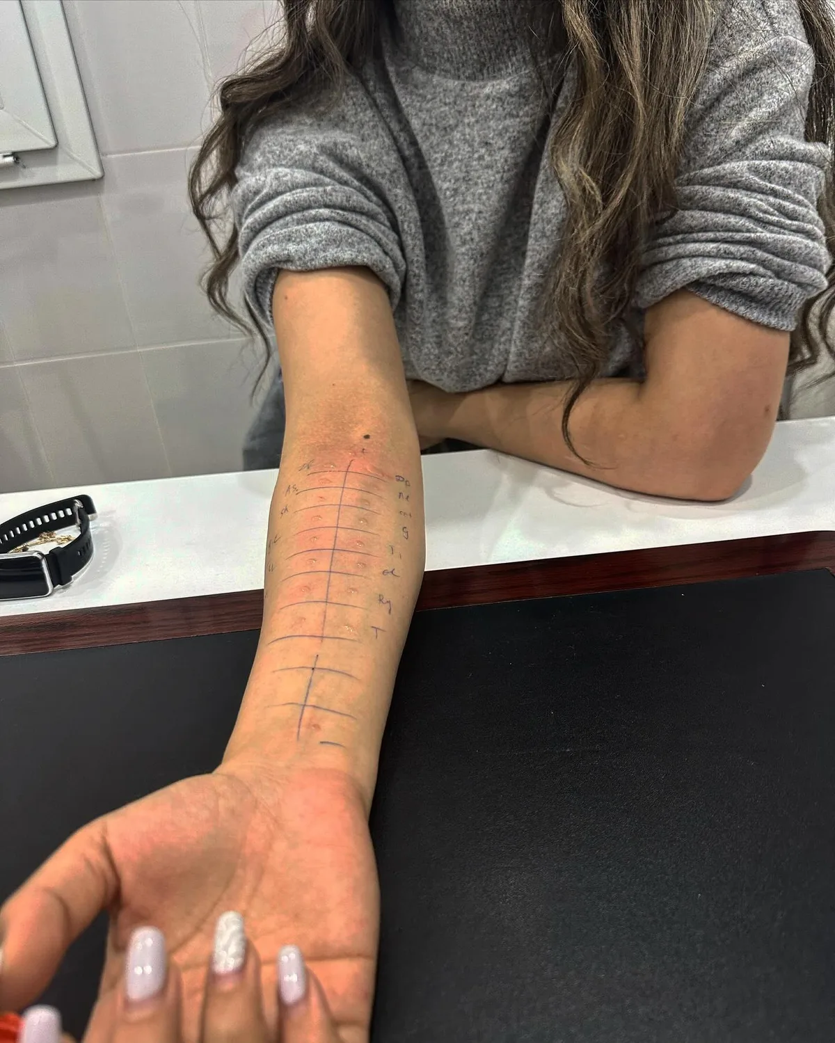 Saiddə işarələnmiş allergen test sahəsi və qiymətləndirmə üçün gözləmə mərhələsi.