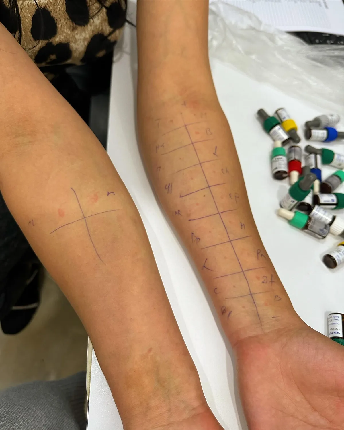 Hər iki saiddə tənəffüs və qida allergenləri üçün işarələnmiş test sahələri və allergen məhlulları.