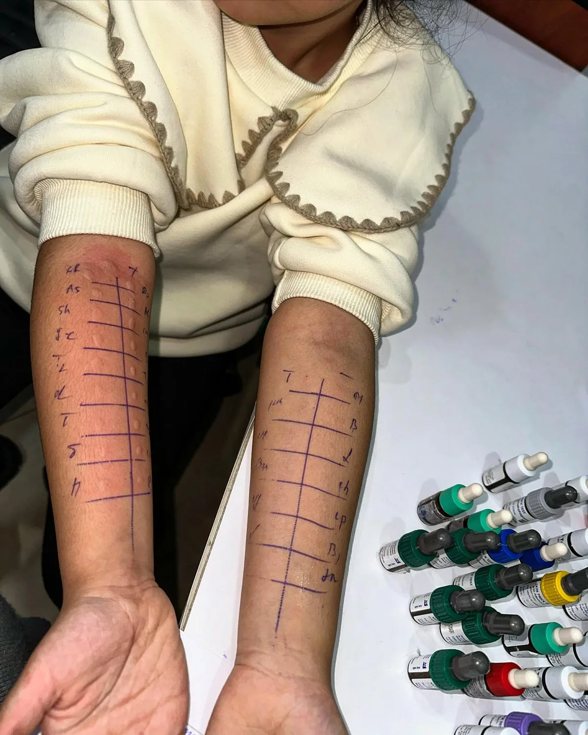 Uşağın hər iki saidində dəri prik testi sahələri; bir neçə nöqtədə qabarıq şəklində müsbət reaksiya var.